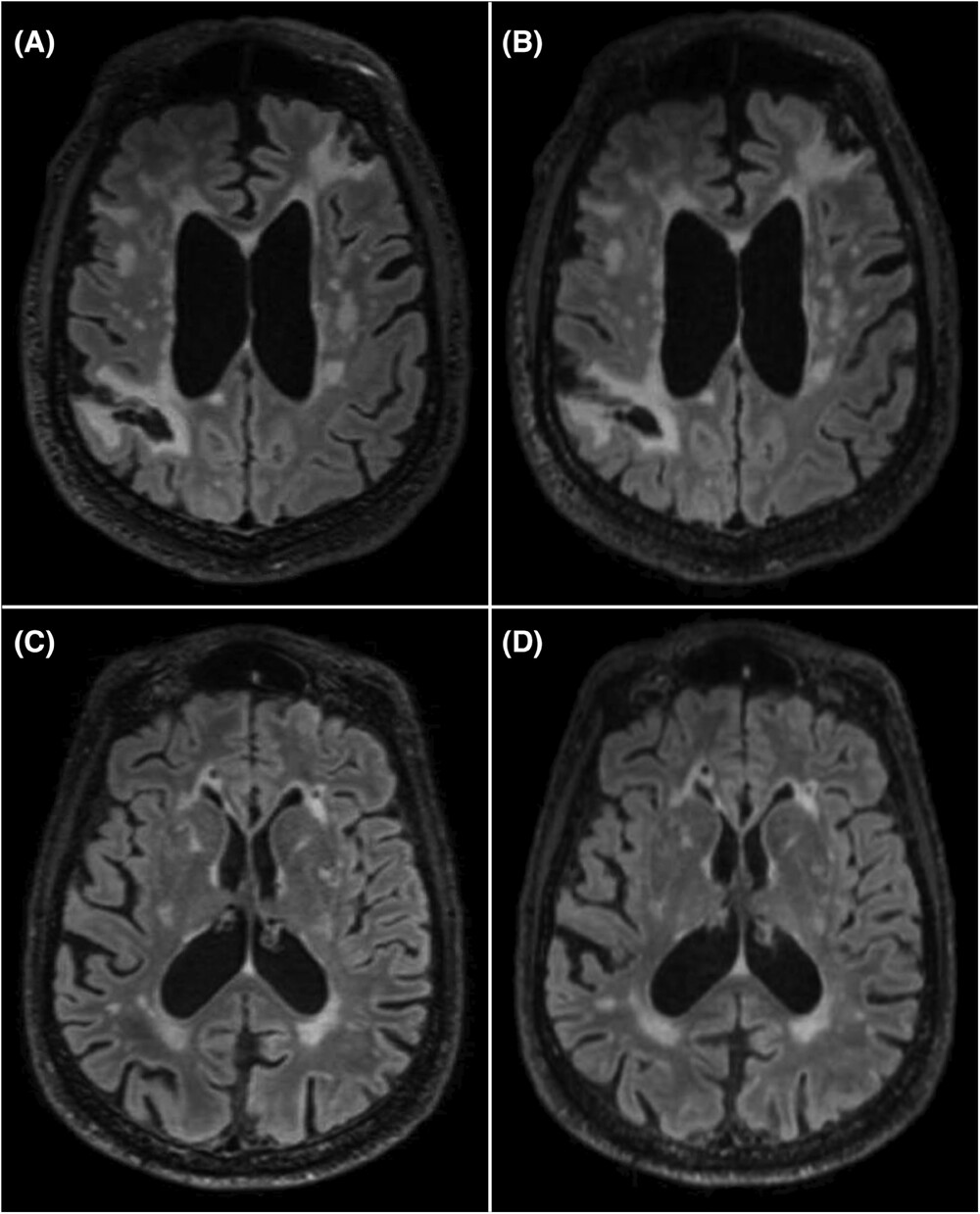 Four brain scans showing very small differences between standard clinical scans on the left hand side to faster scans on the right.