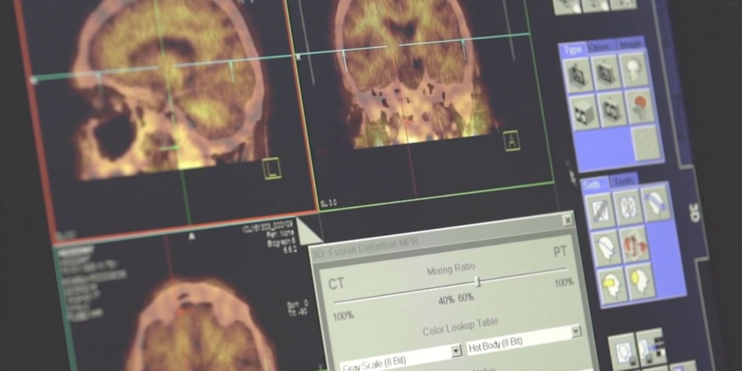 An example of a PET scan